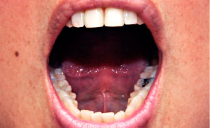 L'absence de dents – et au Québec 40% des personnes âgées de 65 ans et plus n'ont plus de dents dans la bouche – prédisposerait à ce type de cancer. L'absence de dents – et au Québec 40% des personnes âgées de 65 ans et plus n'ont plus de dents dans la bouche – prédisposerait à ce type de cancer.