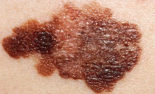 Melanoma. Source : National Cancer Institute. undefined