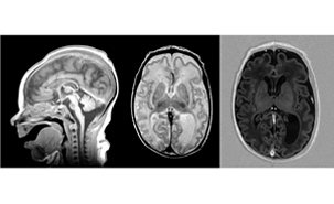 A genetic defect disrupts brain development by affecting the synthesis of asparagine, an amino acid until now thought to be non-essential. The discovery was made by researchers at CHU Sainte-Justine and the University of Montreal. This image shows MRI Images taken from a child who later died from the defect.